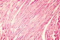 Heart hypertrophy photomicrograph