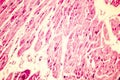 Heart hypertrophy photomicrograph Royalty Free Stock Photo