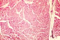 Heart hypertrophy photomicrograph