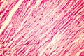 Heart hypertrophy photomicrograph