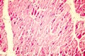 Heart hypertrophy photomicrograph