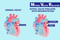 Heart with mitral valve prolapse Royalty Free Stock Photo