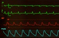 Heart Monitor with Intraventricular Conduction Delay on EKG