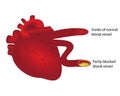 Heart with normal and partly blocked blood vessel