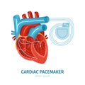 Heart Pacemaker Illustration Royalty Free Stock Photo