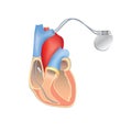 Heart pacemaker in work. Human heart anatomy with ICD Royalty Free Stock Photo