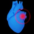 Heart with pathologies localized Royalty Free Stock Photo