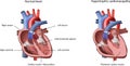 Heart Problem Hypertrophic Cardiomyopathy Royalty Free Stock Photo
