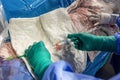 Heart stent placement process in operating room. Heart doctor inserting central venous catheter, Jugular venous catheterization. A Royalty Free Stock Photo