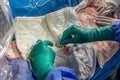 Heart stent placement process in operating room. Heart doctor inserting central venous catheter, Jugular venous catheterization. A Royalty Free Stock Photo