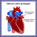 Heart structure. Mitral valve prolapse. Cardiac pathology Royalty Free Stock Photo