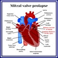 Heart structure. Mitral valve prolapse. Cardiac pathology Royalty Free Stock Photo