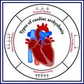 Heart structure. Types of cardiac arrhythmia. Royalty Free Stock Photo