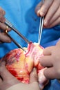 Heart transplant in the hands of surgeons