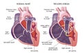 Heart with tricuspid atresia