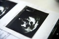 Heart ultrasound image print on paper