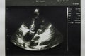 Heart ultrasound image print on paper