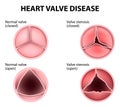 Heart valve disease Royalty Free Stock Photo