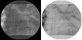 Heart xray with two two cavity pacemaker leads in left atrium and ventricle and shadow of artificial mitral valve