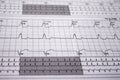 Heartbeat represented on paper. Cardiac arrhythmias. Selective focus on some beats. Atrial fibrillation Intraventricular