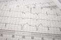 Heartbeat represented on paper. Electrocardiogram of patient with pacemakers with malfunction. Failure of sensing of extra systole