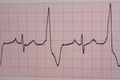 Heartbeats recorded on an electrocardiogram. cardiac arrhythmia