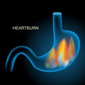 Heartburn. Blue realistic stomach with flame on dark background