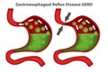 Heartburn or gastroesophageal reflux disease