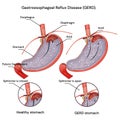 Heartburn and Gastroesophageal Reflux. Disease (GERD). Acid reflux.