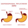 Heartburn and Gastroesophageal Reflux Disease GERD.Concept health Royalty Free Stock Photo