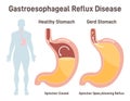 Heartburn or Gastroesophageal Reflux Disease. Stomach acid