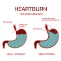 Heartburn Stomach disease.Indigestion and stomach pain problems.Human anatomy