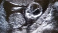 Hearth of baby before birth ultrasound image showing s