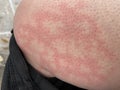 Heat rash hives allergy reaction knee close-up reference picture of blotchy mottled red skin erythema ab igne also known as EAI