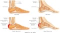 Heel Bursitis