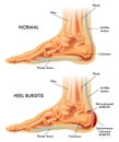 Heel bursitis illustration