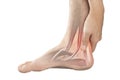 Heel muscle pain