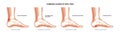 Heel pain diagram Royalty Free Stock Photo