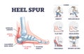 Heel spur or calcaneal bone condition causing pain in feet outline diagram