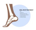 Heel spur treatment