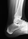 Heel Xray Royalty Free Stock Photo