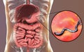 Helicobacter pylori, bacterium colonizing stomach