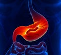 Helicobacter Pylori - Stomach Royalty Free Stock Photo