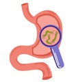 Helicobacter Pylori in the stomach. Bacteria under magnifying glass. Stomach diseases. Unhealthy stomach concept. Heartburn,