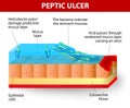 Helicobacter pylori and ulcers disease