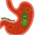 Helicobacter pylori. Ulcers. Royalty Free Stock Photo