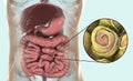 Helminths nematodes Enterobius in the gut