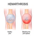 Hemarthrosis is a bleeding into joint spaces