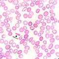 Hematological slide showing Elliptocyte, abnormal RBC, Iron deficiency anemia. Pencil cell.