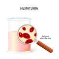 Hematuria. magnifying glass and beaker with urine. Closeup of Red blood cells Royalty Free Stock Photo